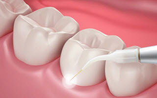 Periodontal Maintenance