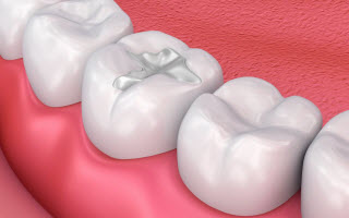 Dental Fillings