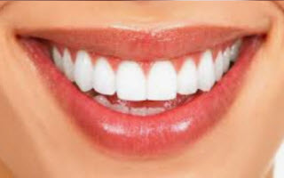 Porcelain Veneers