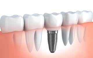 Dental Implants